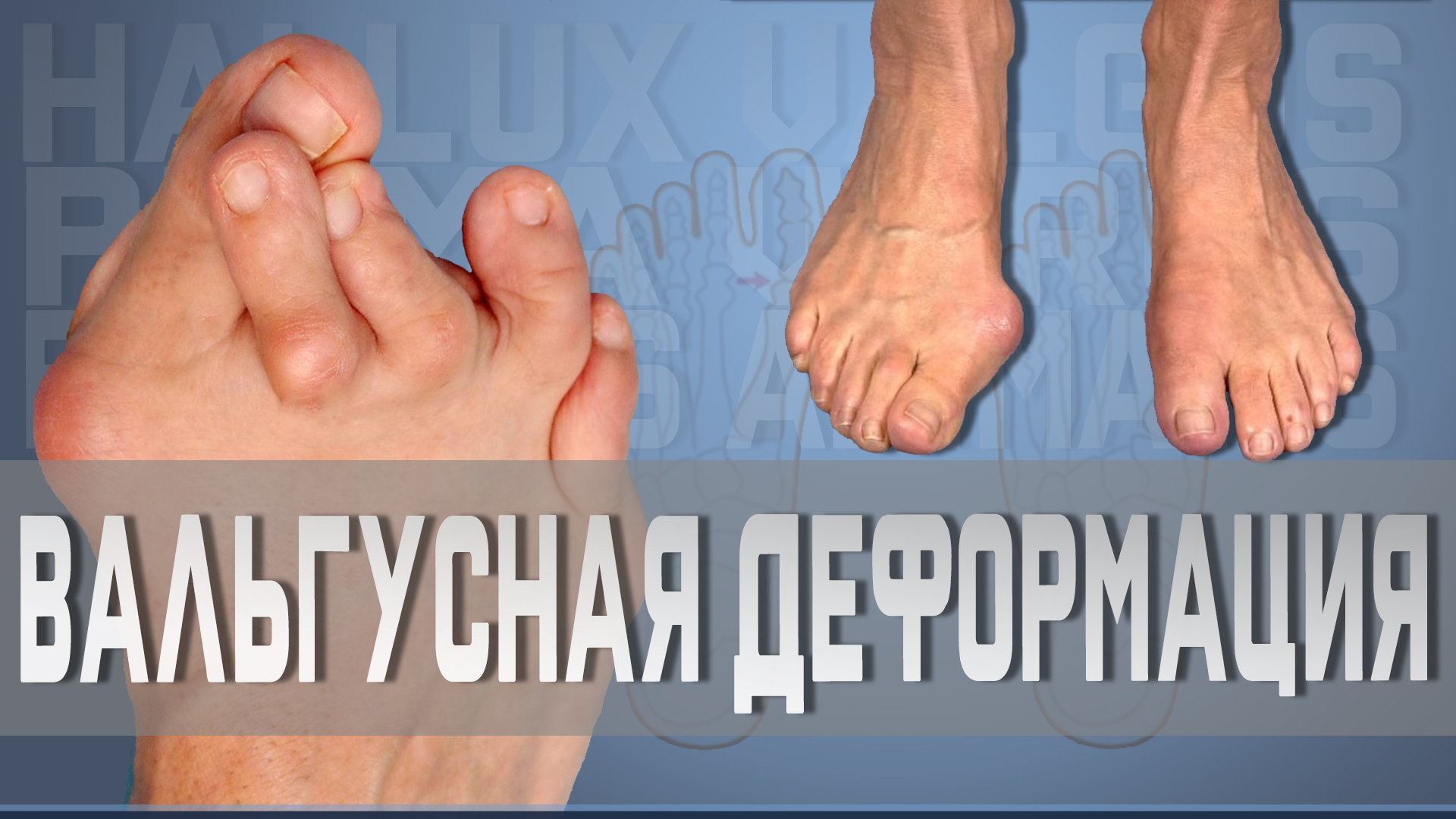 Вальгусная деформация большого пальца смотреть онлайн
