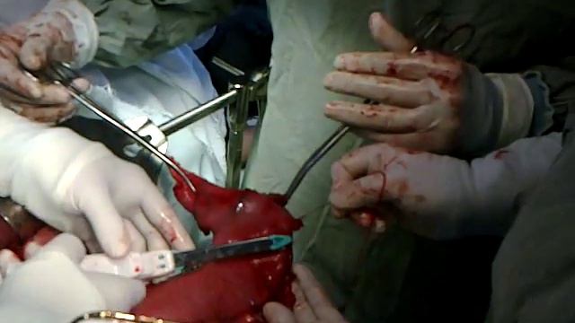 Dr.Fariz Camalov qida borusu(искуственный пищевод) смотреть онлайн