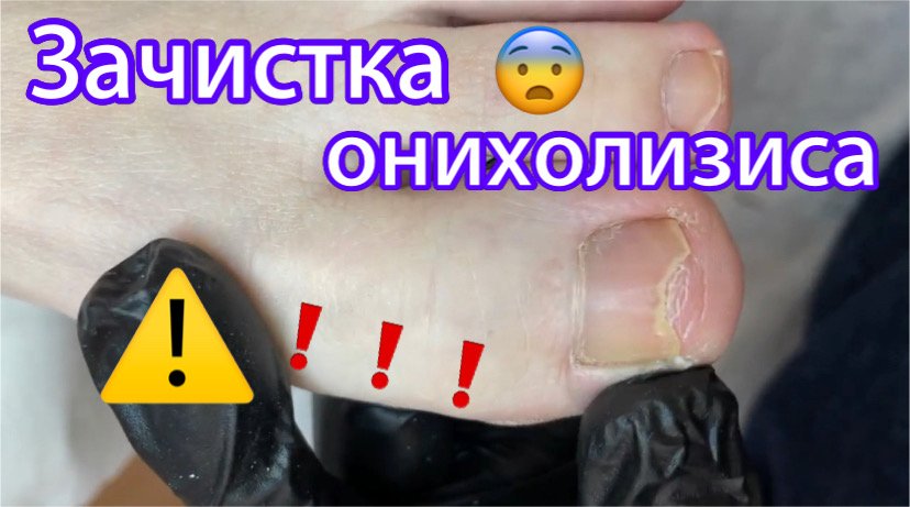 Зачистка онихолизиса ?⚠️❗️?? смотреть онлайн