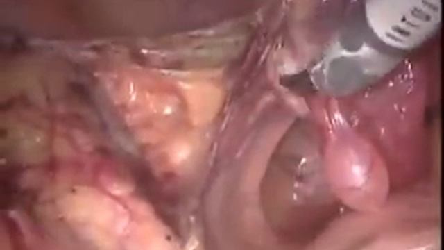 da Vinci S / Robotic Hysterectomy by M. Patrick Lowe MD смотреть онлайн