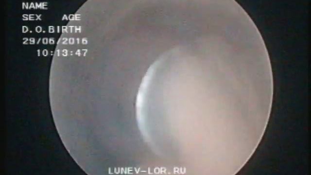 Удаление гребня перегородки носа эндоскопическая лазерная кристотомия 29062016 2 смотреть онлайн