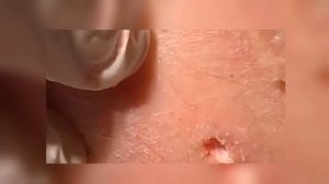 Огромные Черные Точки. Чистка лица/ blackhead removal/