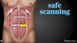 Блокада фасции прямой мышцы живота под УЗ-навигацией (Rectus Sheath Block).