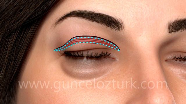 Alt - Üst Göz Kapağı Estetiği Ameliyatı (Blefaroplasti) Nasıl Yapılır ? Dr. Güncel Öztürk - #DRGO смотреть онлайн
