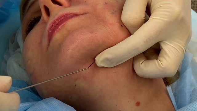 Нитевая подтяжка. смотреть онлайн