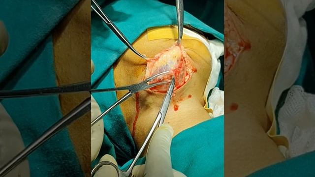 submandibular cystic lesion. excision. dr jalil mujawar смотреть онлайн