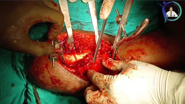 Proximal Humerus fracture Plating|Deltopectoral Approach|PHILOS Plating|Humerus fracture surgery смотреть онлайн