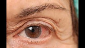 Как лечить и лечить конъюнктивит