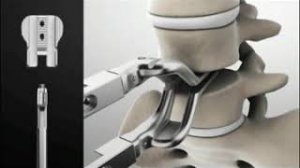 Установка протеза межпозвонкового поясничного диска M6-L