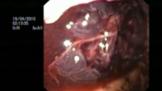 видео 1 НЭпО ЖКК диагностика смотреть онлайн