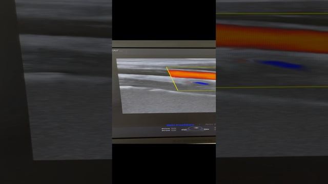 Сосудистый чекап. Идеальный кровоток в сонной артерии. Узи. Сосудистый хирург. Флеболог Москва смотреть онлайн