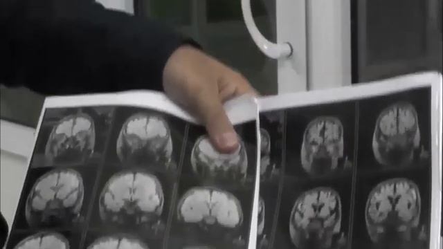 BOSH MIYANI TOTAL ATROFIYASI. BOSH MIYA TO'QIMALARI QAYTA TIKLANMAYDIKU. смотреть онлайн