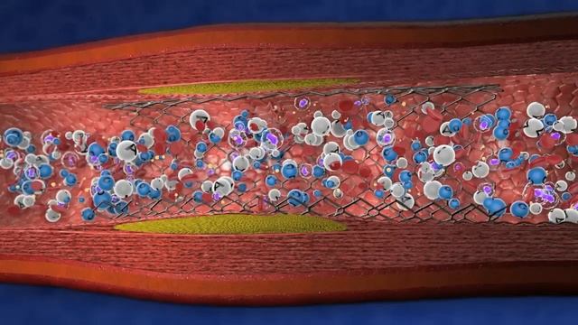 Clopidogrel: anti trombótico y anti plaquetario. смотреть онлайн