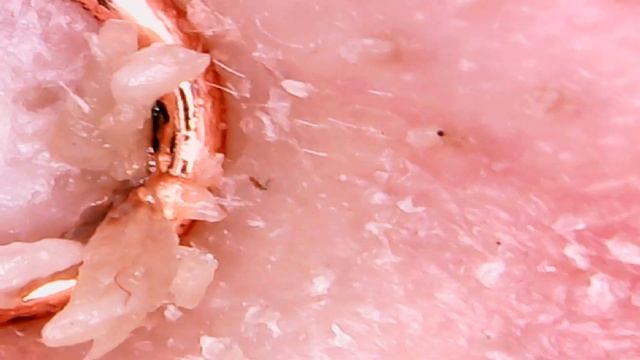 ЭТОТ ЛИЦЕВОЙ КЛЕЩ РЕАЛЬНО ЖИВЕТ НА ВАШЕМ ЛИЦЕ? (DEMODEX / КЛЕЩ ЖЕЛЕЗНИЦА)