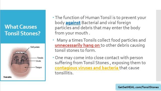 Get Rid of Tonsil Stones Today смотреть онлайн