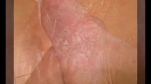 Грибок на ногах