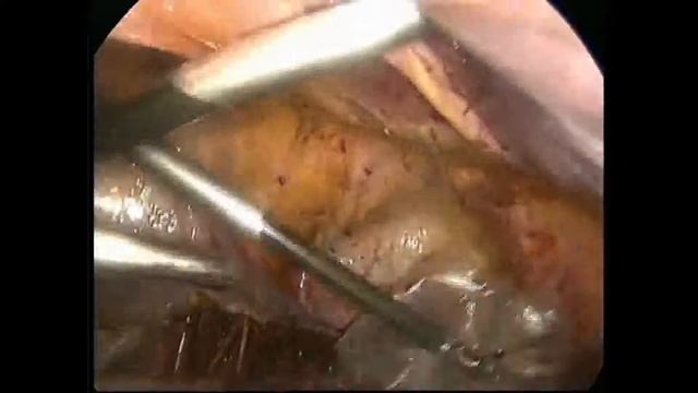 Iliac lymph node dissection as part of Laparoscopic Hysterectomy for Carcinoma Endometrium смотреть онлайн