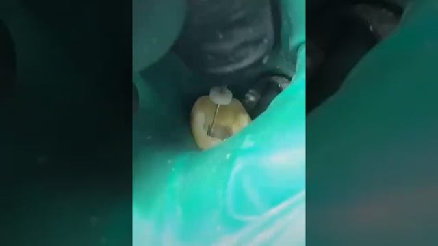 Пошаговое удаление нерва зуба. смотреть онлайн