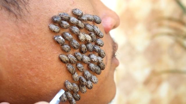 We Help Cleaning Million Big Ticks on Face Man #023 смотреть онлайн