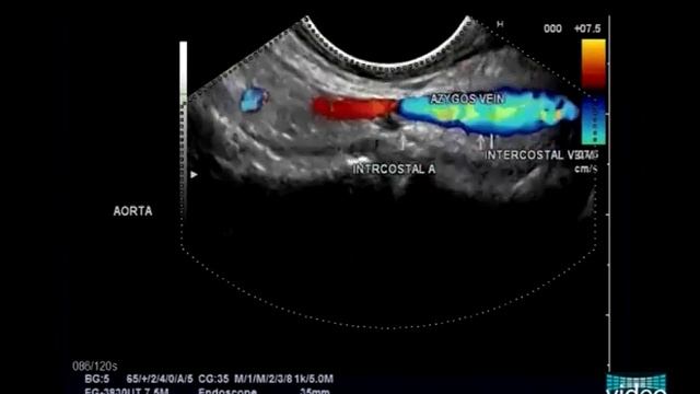 Endosonography of the Normal Mediastinum: The Experts Approach смотреть онлайн