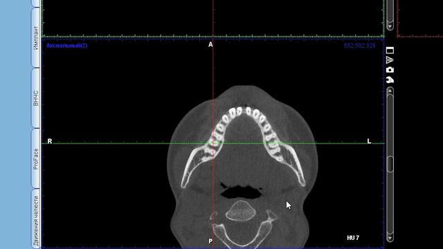 Возможности программы Romexis Viewer: настройка на многокорневой зуб смотреть онлайн