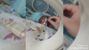 недоношенный ребёнок 26 недель радился 3 месяца раньше / վաղաժամ ծնված երեխա  26 շաբաթական