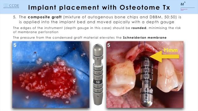 Facebook Case Osteotome Tx - 2018-Oct смотреть онлайн