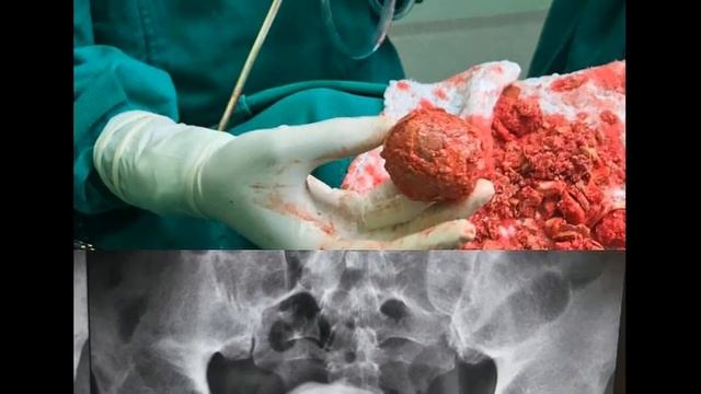 Камни мочевого пузыря смотреть онлайн