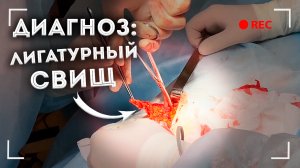 ЛИГАТУРНЫЙ СВИЩ | ОТВЕТЫ НА ВОПРОСЫ