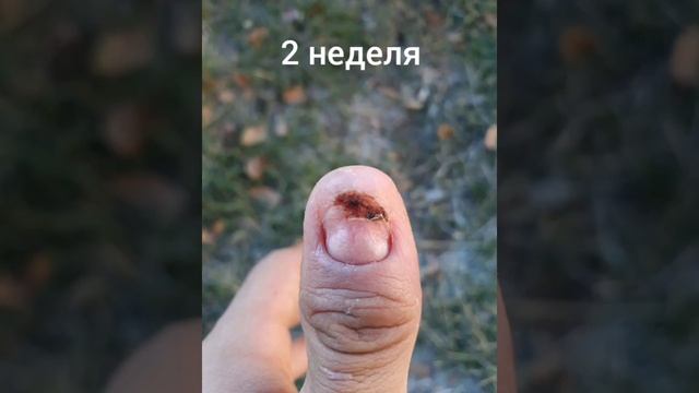 Жесть! Как растут ногти. После удаления. смотреть онлайн