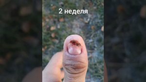 Жесть! Как  растут  ногти. После удаления.