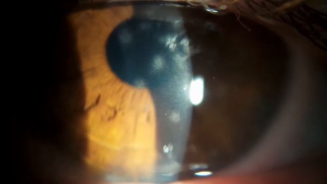 Аденовирусный кератит смотреть онлайн