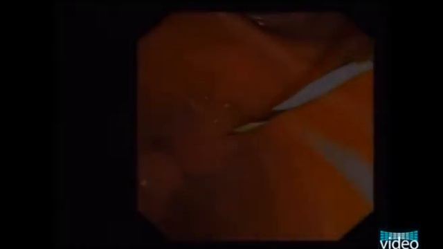 Endoscopic Retrograde Cholangiography in a Patient with Billroth II Type Gastroenterostomy смотреть онлайн