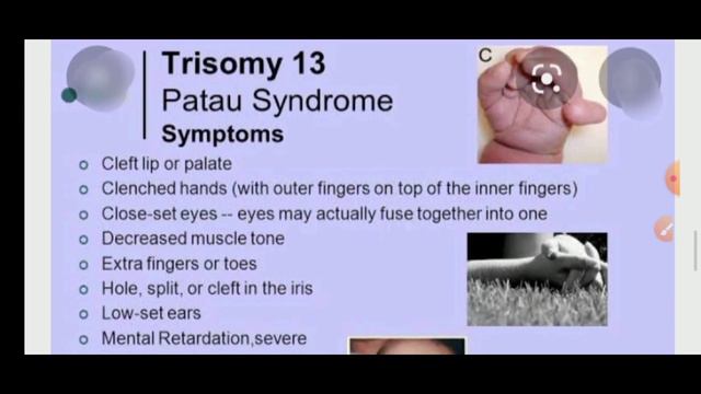 Patu's Syndrome (trisomy 13)/Causes ,sign & Symptoms/Dr Manisha Dubey смотреть онлайн