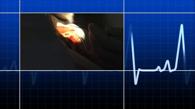 Как проводится лечение отслойки сетчатки глаза?