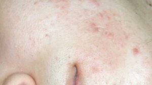 ЧЁРНЫЕ ТОЧКИ ?Как убрать их НАВСЕГДА?! ИНСТРУМЕНТЫ  для удаления чёрных точек. ЛОЖКА УНО - помощник