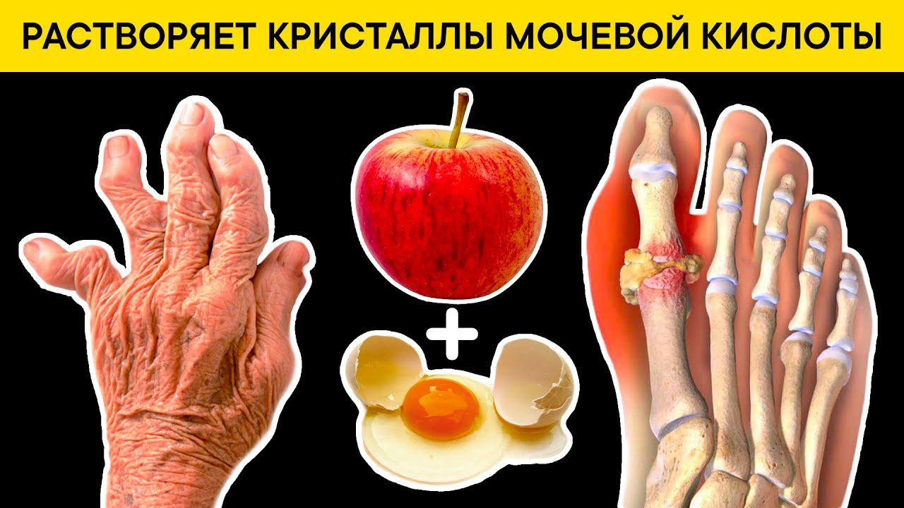 АРТРИТ и ПОДАГРА обойдут стороной. Моментальное растворение КРИСТАЛЛОВ МОЧЕВОЙ КИСЛОТЫ смотреть онлайн