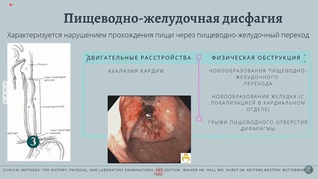 Дисфагия. Причины и классификация.