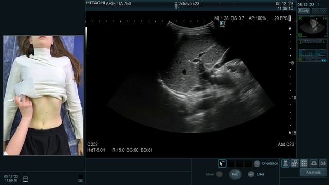 ВОЗМОЖНОСТИ НОВОГО МИКРОКОНВЕКСНОГО ДАТЧИКА С23 | Кириллова М.С. смотреть онлайн