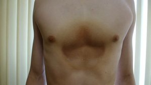 ВДГК 2 степени после 5 месяцев лечения вакуумным корректором (колоколом)