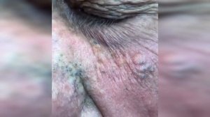 подборка выдавливания прыщей 33 II выдавливание прыщей