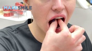 Как надевать и снимать ретенционные капы?