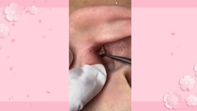 Treatment of Blackheads and Hidden Acne 003 / dr pimple popper смотреть онлайн