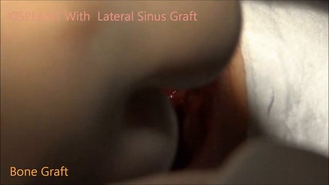 lateral sinus lift смотреть онлайн