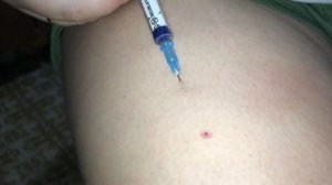 Как сделать укол подкожно в ногу у себя дома. Краткая инструкция по действиям.