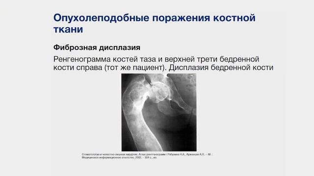 Опухолеподобные заболевания мягких тканей лица, шеи. Кисты челюстно-лицевой области. Часть 2 смотреть онлайн