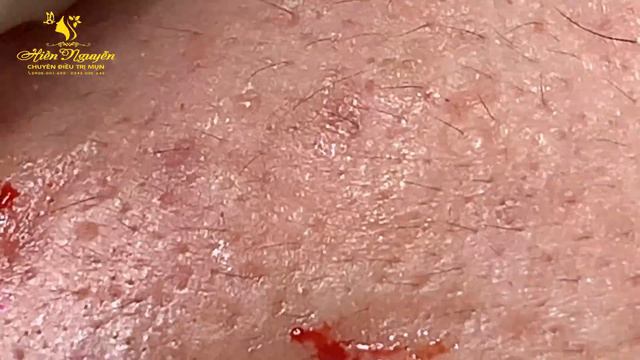 Satisfying Hien Spa Beauty Relaxing Video #03