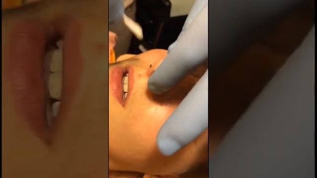 Incorrect Septum Puncture Не Правильно сделали Септум ?