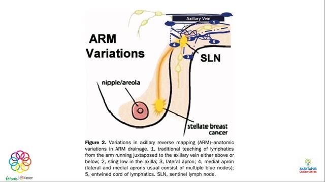 Axillary Reverse Mapping in a case of Carcinoma Breast смотреть онлайн