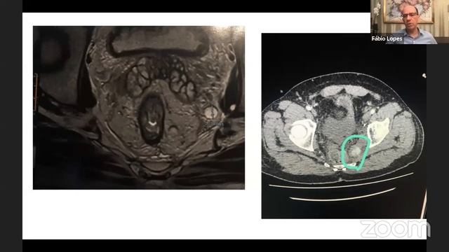 Linfadenectomia Pélvica Lateral смотреть онлайн